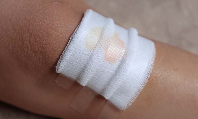 prikaz rane sa flasterom