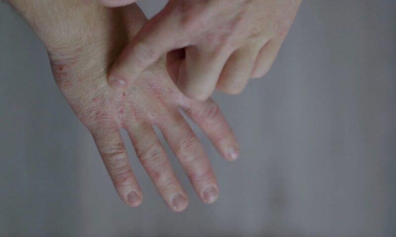 prikaz suvih i ispucalih dlanova